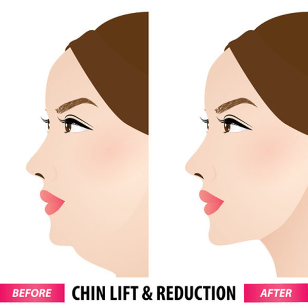 chin reduction