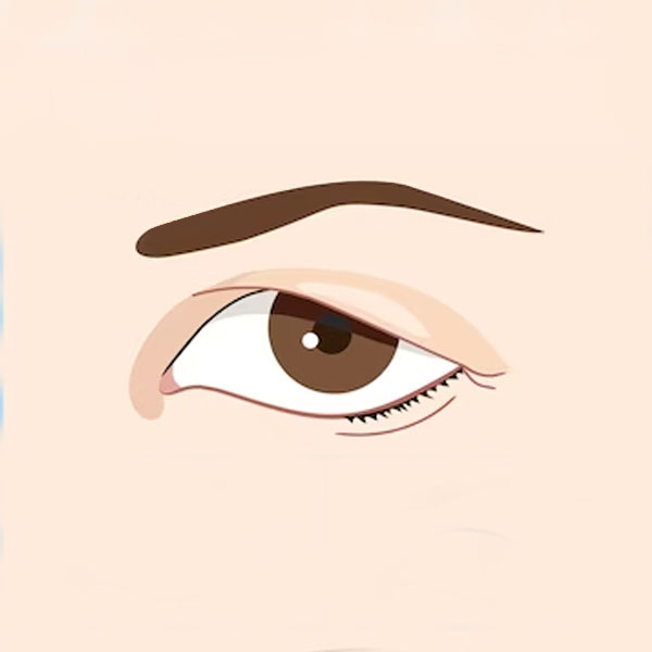 eyelid reduction