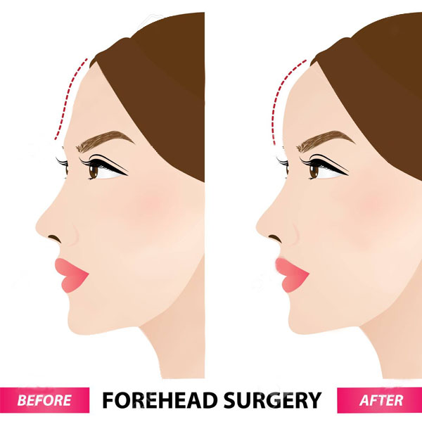 forehead reduction