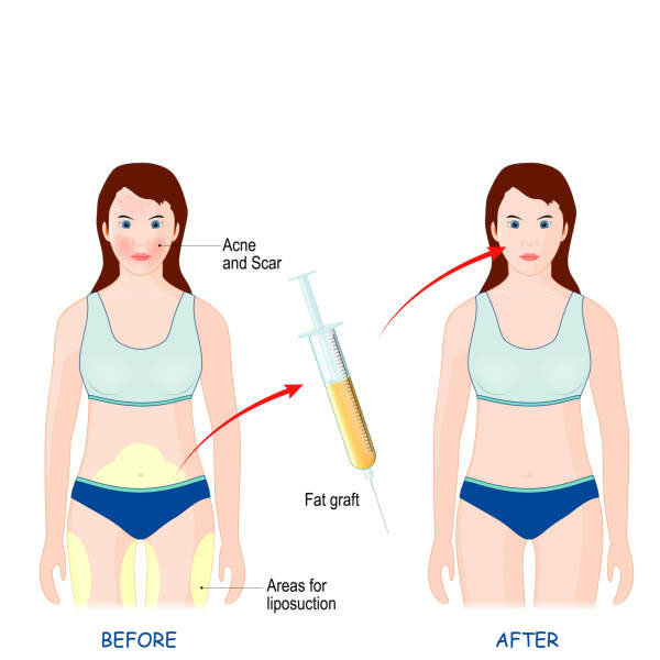 fat injections