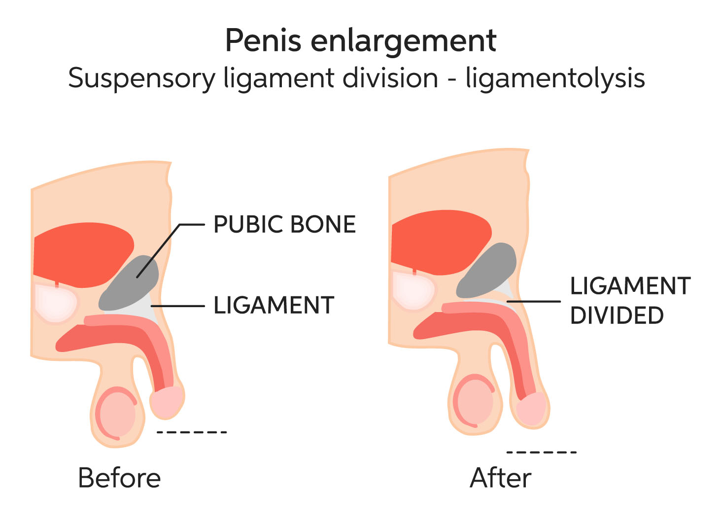 Penile Enlargement