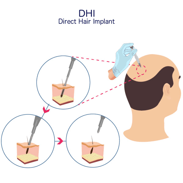 DHI Hair Transplant in bangalore