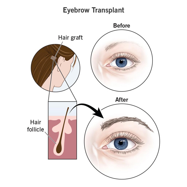 Eyebrow Hair Transplant